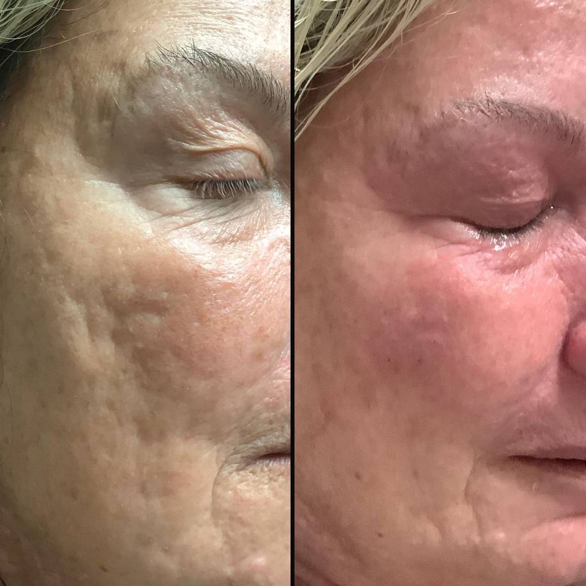 Lasers For Face | Pearl Fractional | Case 4