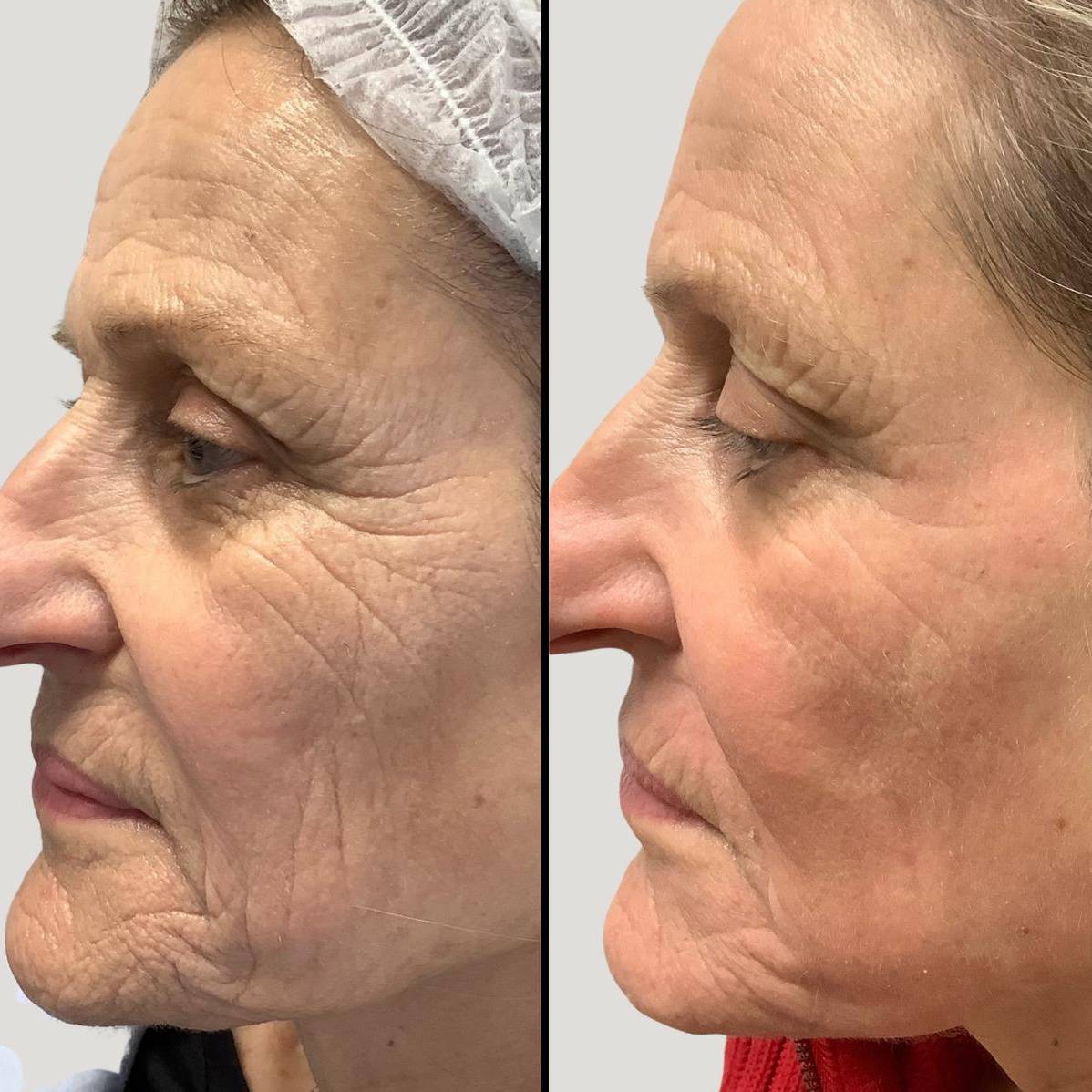 Lasers For Face | Pearl Fractional | Case 5