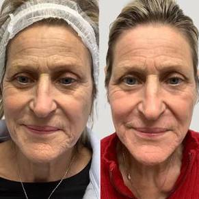 Lasers For Face | Pearl Fractional | Case 6