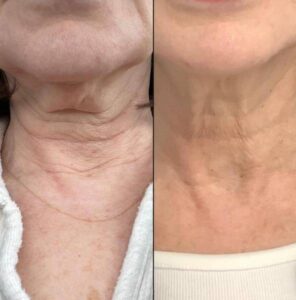 Lasers For Neck | CO2 | Case 1