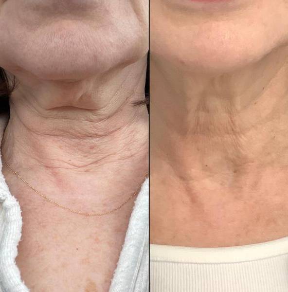 Lasers For Neck | CO2 | Case 1