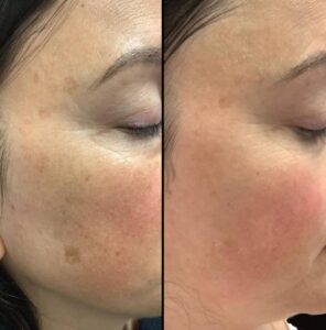 Lasers For Uneven Skin Tone | IPL | Case 2