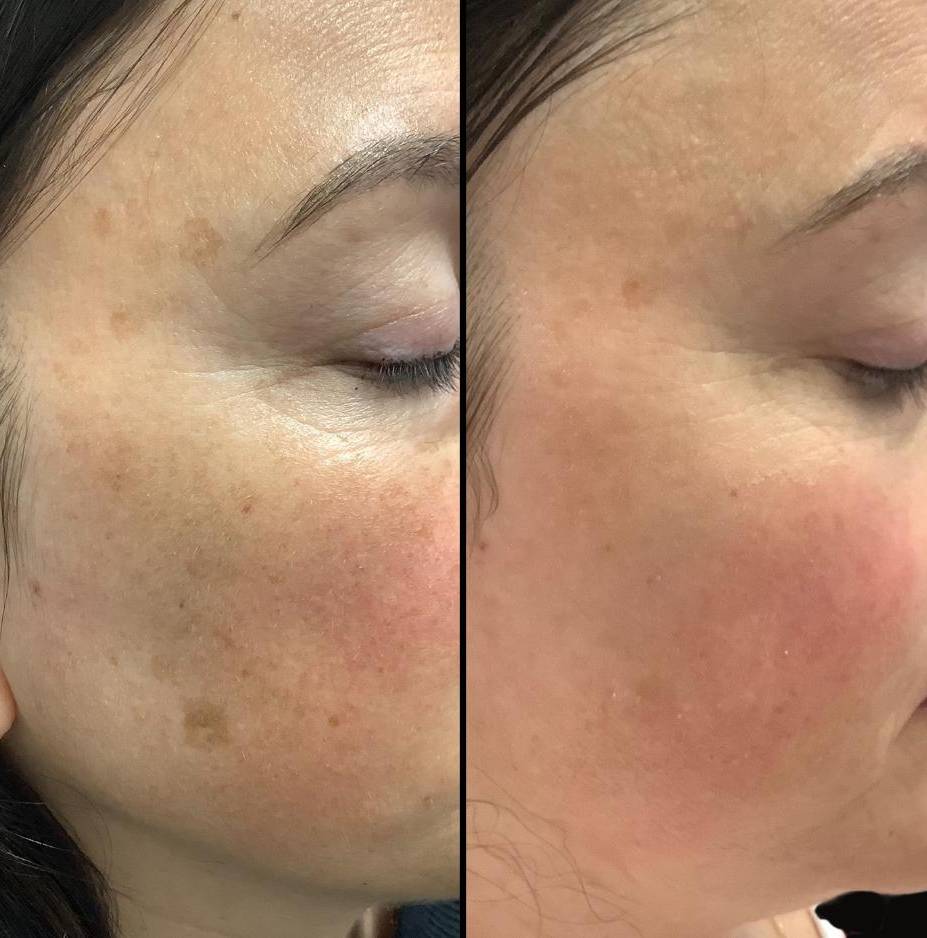 Lasers For Uneven Skin Tone | IPL | Case 2
