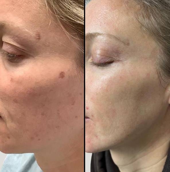 Lasers For Uneven Skin Tone | IPL & Peel | Case 1