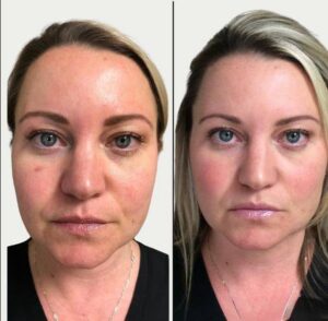 Medi Facial With Aquagold