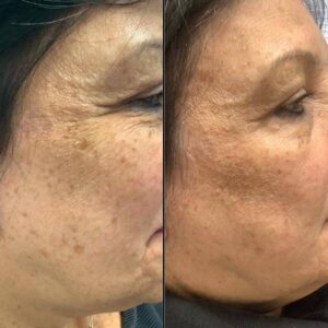 Pigment Correction
