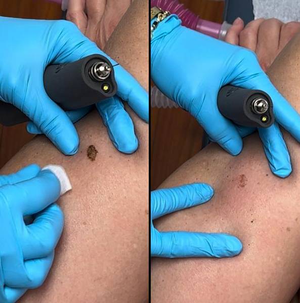 Skin Treatments For Body | Plasma Pen | Case 1
