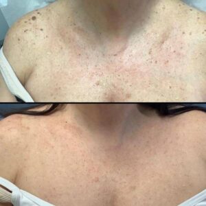 Skin Treatments For Chest | Plasma Pen | Case 1
