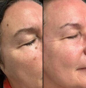 Skin Treatments For Moles | Plasma Pen | Case 1