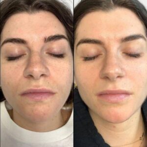 Traditional Microneedle | Case 1