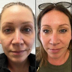 Under And Upper Eye Lid | Plama Pen