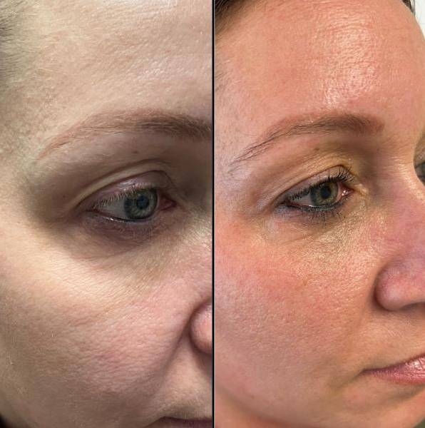 Under And Upper Eye Lid | Plama Pen - right eye