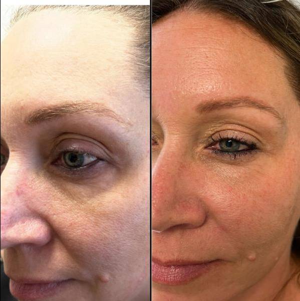 Under And Upper Eye Lid | Plama Pen - Left Eye