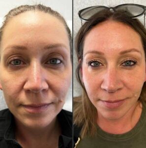 Upper And Lower Eye Lid Rejuvenation - eye lids