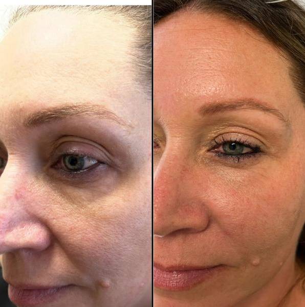 Upper And Lower Eye Lid Rejuvenation - left eye