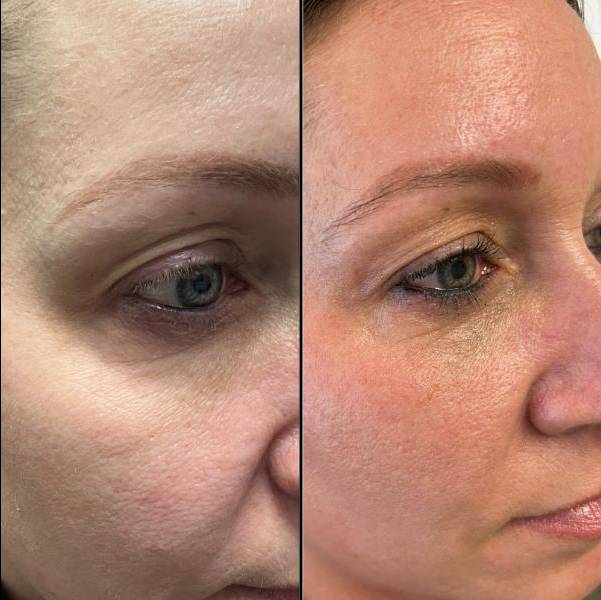 Upper And Lower Eye Lid Rejuvenation - right eye