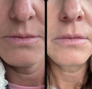 Vertical Lip Lines | Skinvive | Case 1
