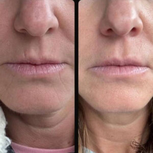 Vertical Lip Lines Skinvive Case 1 sq