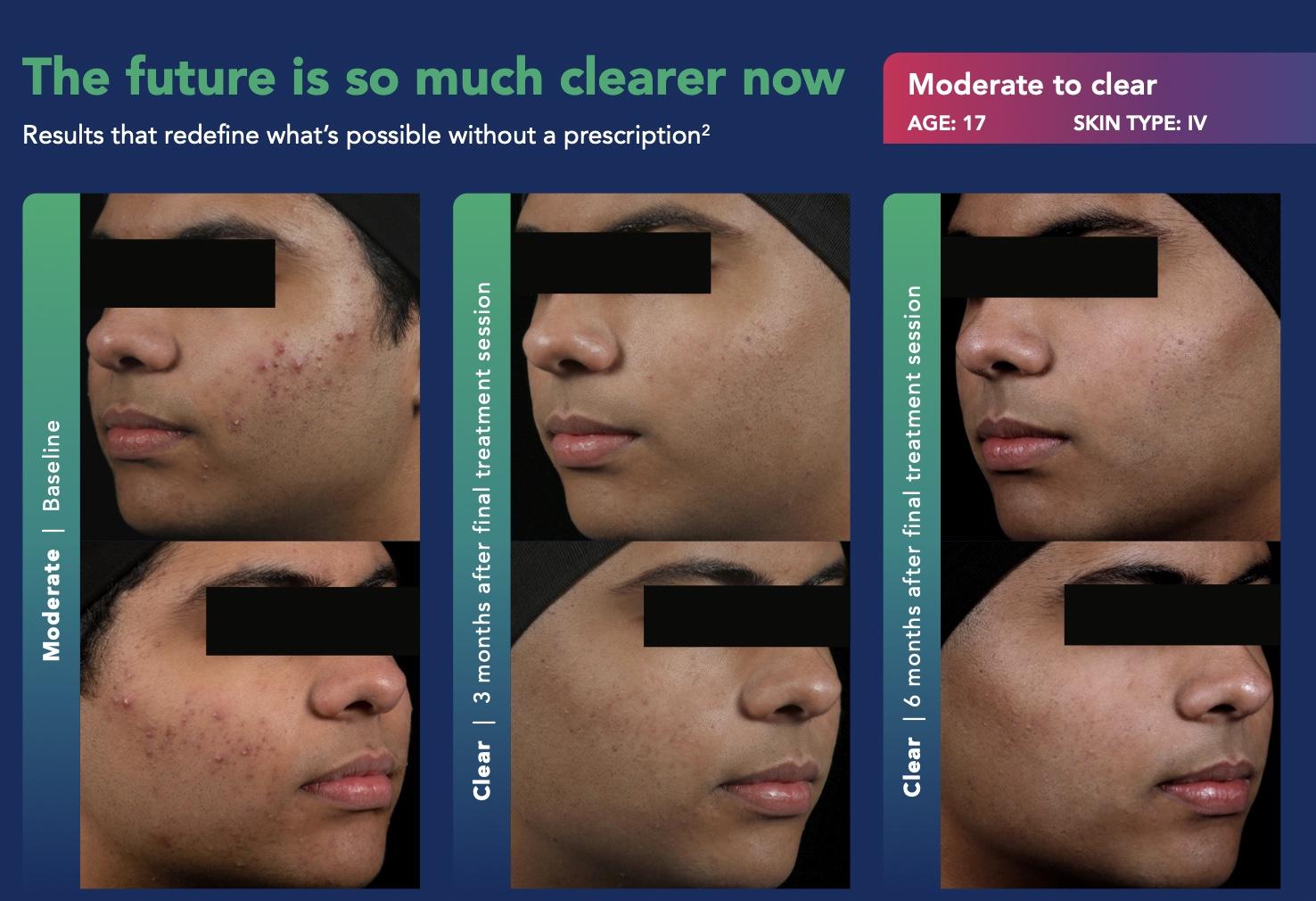 AviClear Results