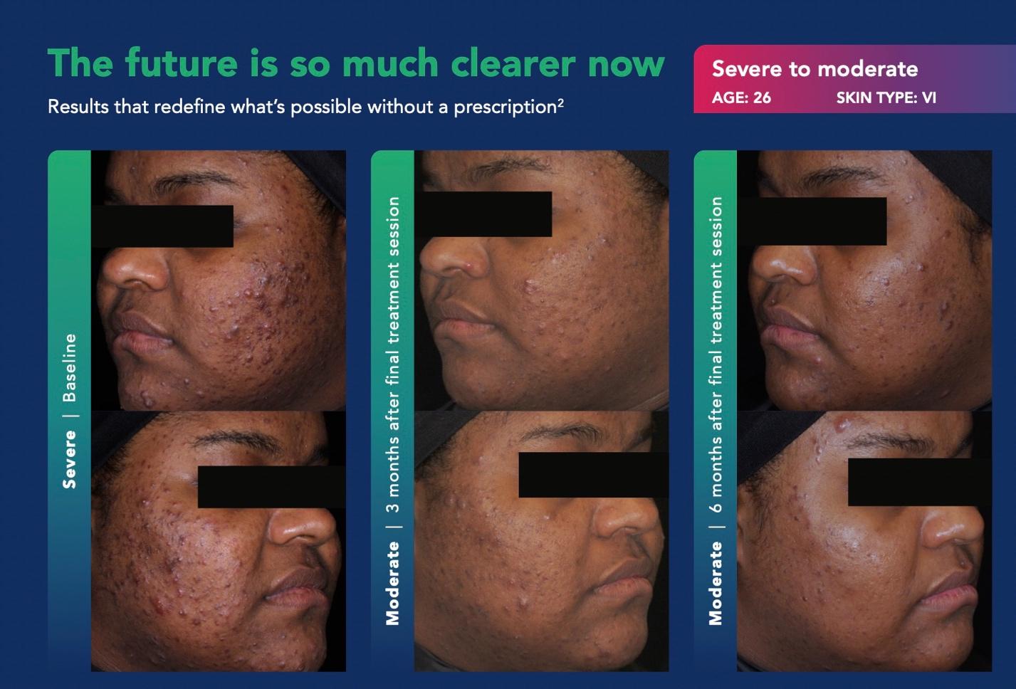 AviClear Results