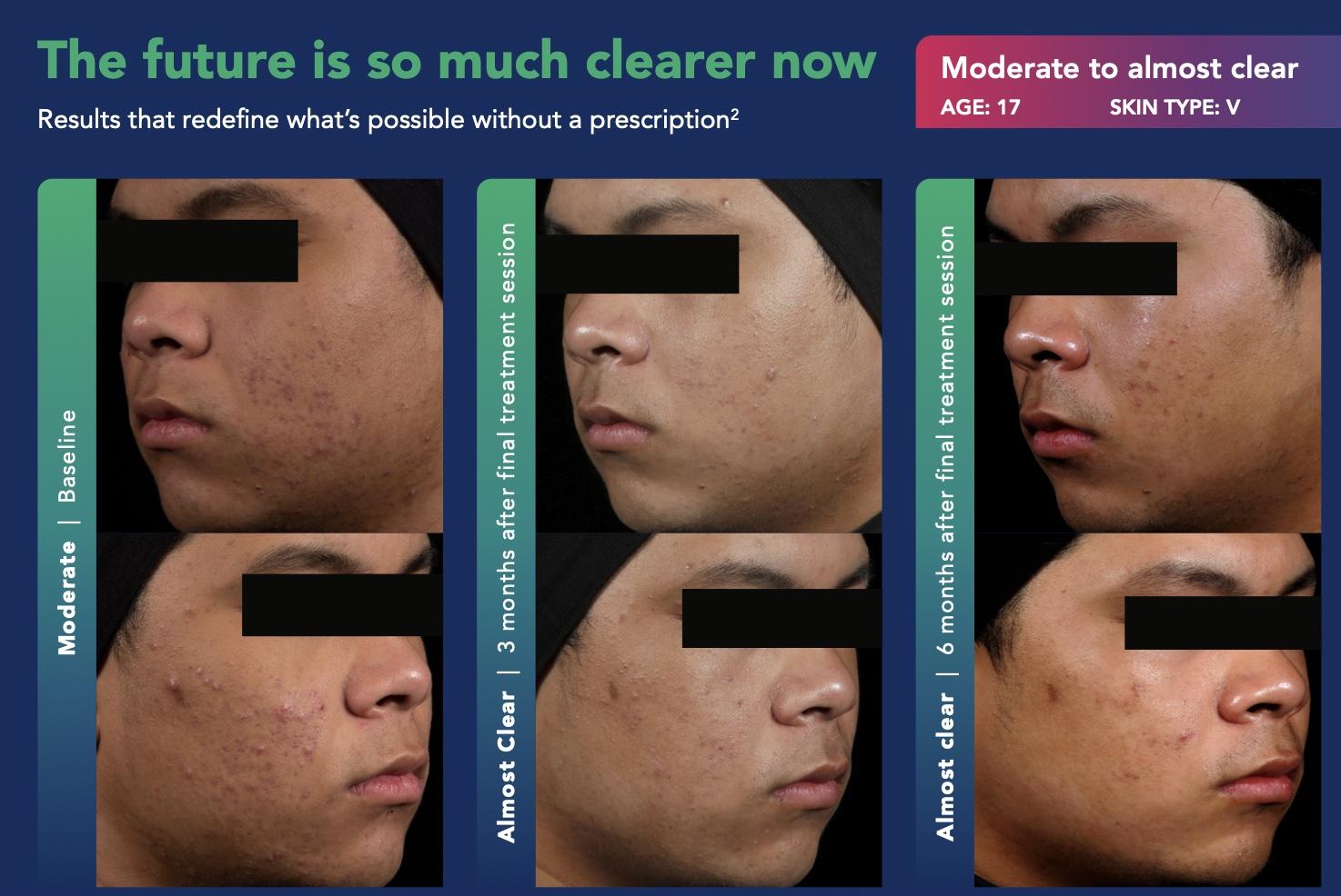 AviClear Results