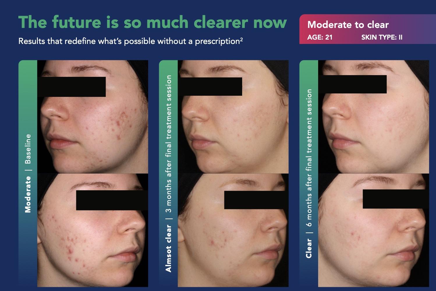 AviClear Results