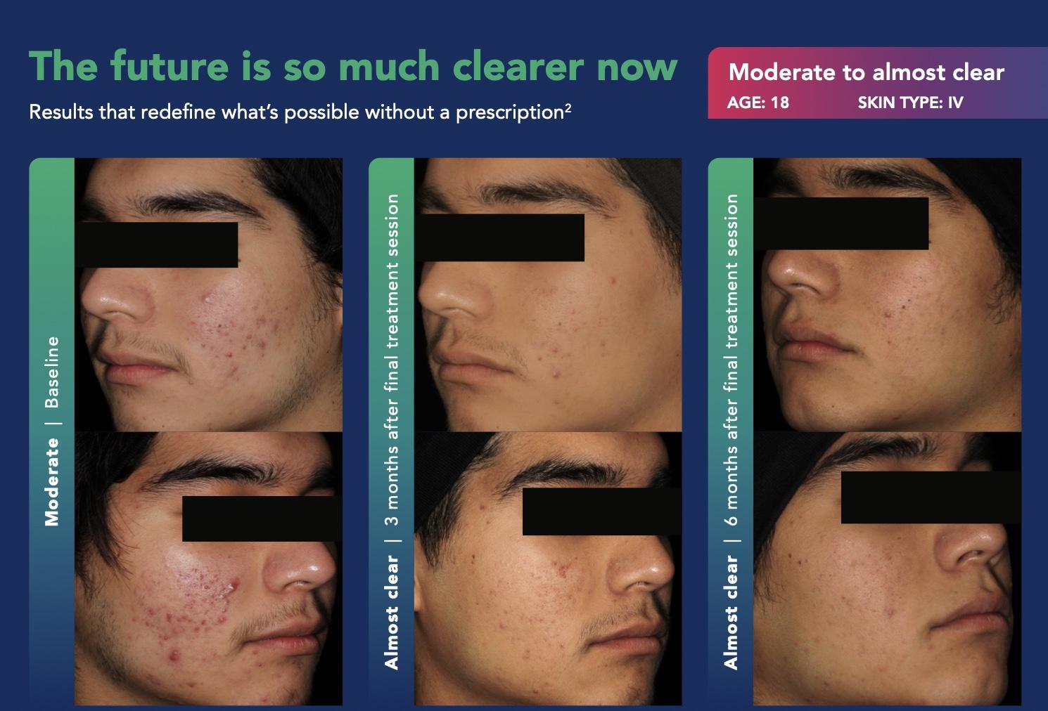 AviClear Results