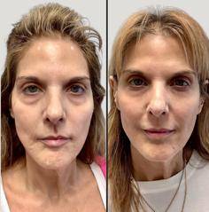 Before And After Botox For Wrinkles In Hammonton, NJ