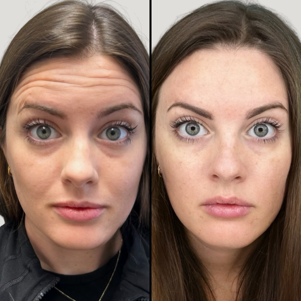 injectable Botox Forehead 4
