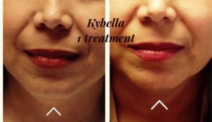 kybella_comp_001