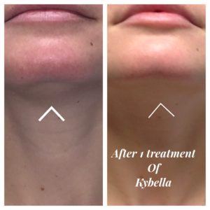 kybella_comp_002