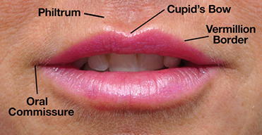 restylane-silk_lip_diagram